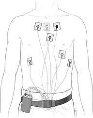 Holter Monitor Patient 2