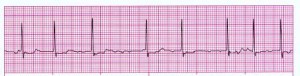 Atrial Fibrillation ECG strip 2