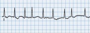 Atrial Fibrillation ECG strip - CardiacMonitoring.com