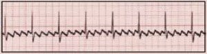 Atrial flutter