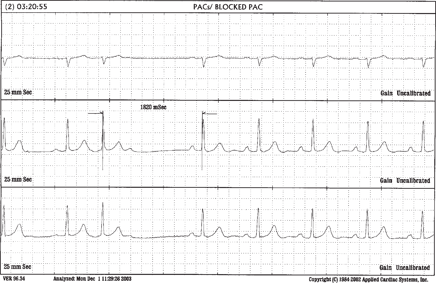 isolated-pac-cardiacmonitoring