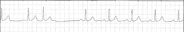 supraventricular-ectopic-beat-cardiacmonitoring