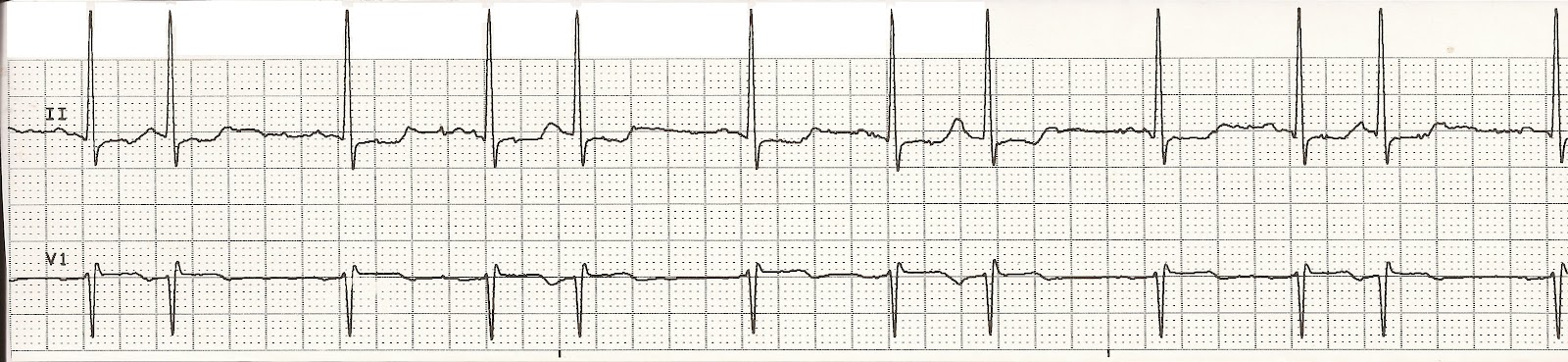 Supraventricular ectopic beat