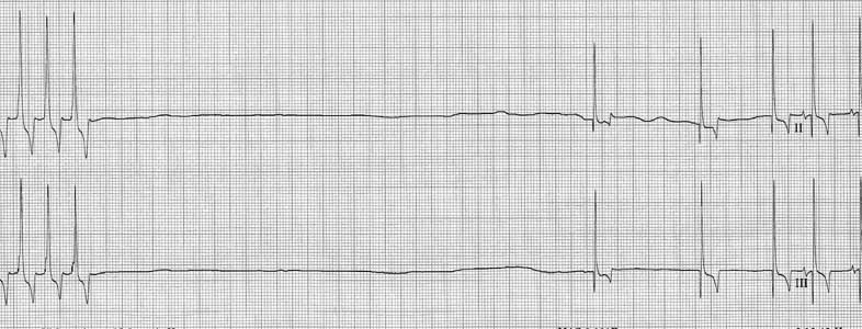 pauses on telemetry