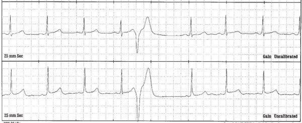 Isolated PVC - Premature Ventricular Contraction CardiacMonitoring ...