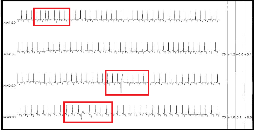 Isolated Premature Arial Contraction And Two Isolated Multi Focal Premature Ventricular